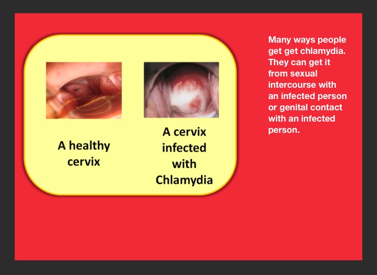 cervix with chlamydia