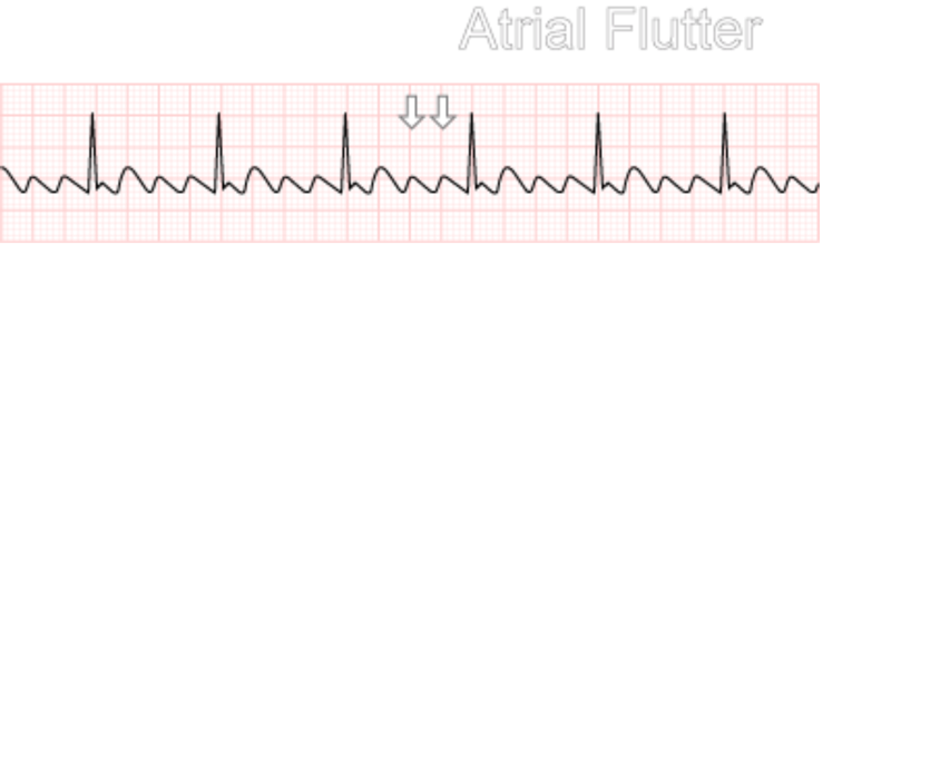 Atrial Flutter on FlowVella - Presentation Software for Mac iPad and iPhone