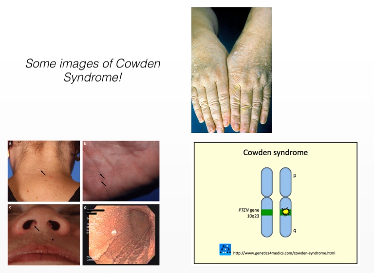 cowdens syndrome