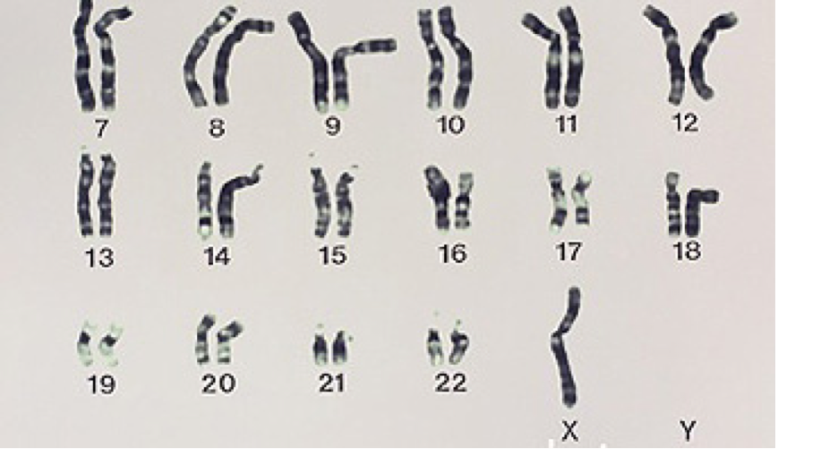 Отсутствие х хромосомы у мужчин. Синдром Шерешевского Тернера кариотип. Синдром Шерешевского Тернера хромосомы. Кариотип больного синдрома Тернера.