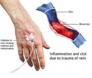 Phlebitis Presentation Copy - Screen 6 On FlowVella - Presentation ...