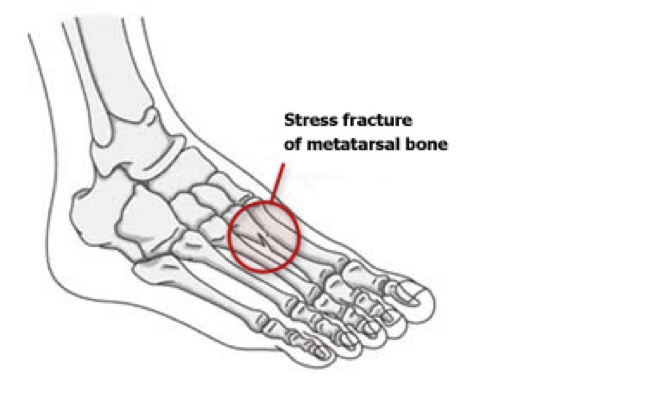 Stress fracture. Перелом ладьевидной кости стопы рентген. Краевой перелом плюсневой кости. Стрессовый перелом 5 плюсневой кости. Стрессовый перелом плюсневой кости стопы симптомы.