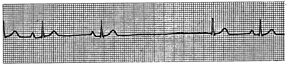 sick-sinus-syndrome-on-flowvella-presentation-software-for-mac-ipad