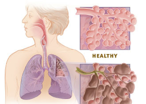 Copd on FlowVella - Presentation Software for Mac iPad and iPhone