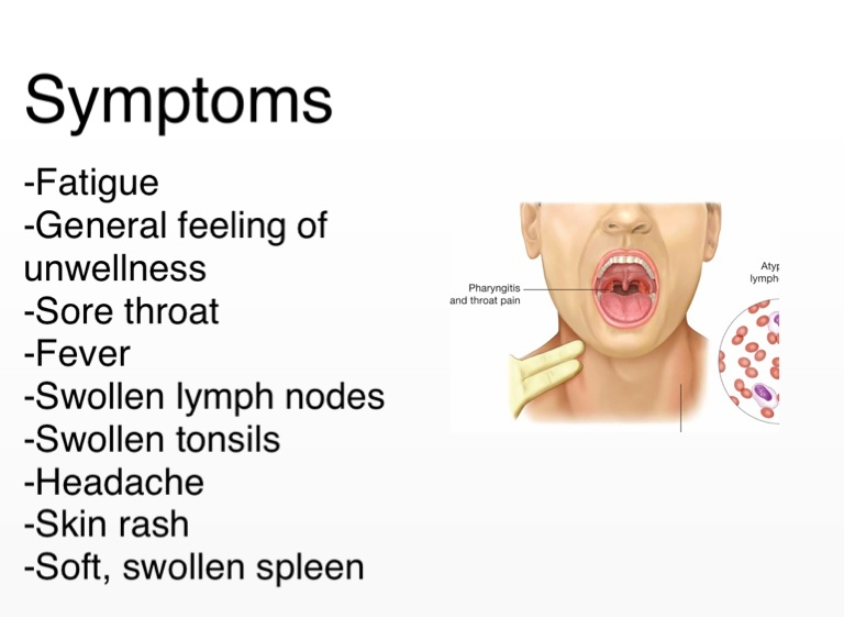 Swollen neck glands headache images