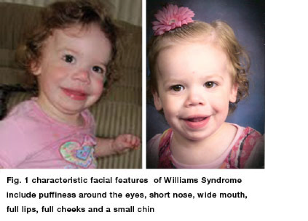 Синдром вильямса фото детей и взрослых