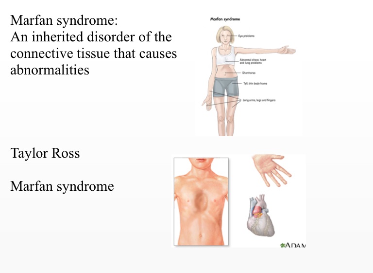 Marfan syndrome copy copy on FlowVella - Presentation Software for Mac ...