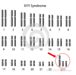 how common is xyy syndrome