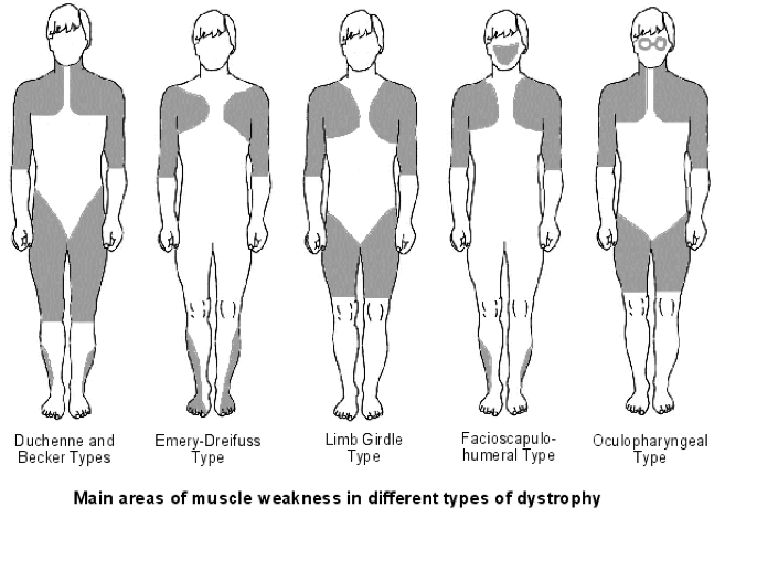 Main areas. Мышечная дистрофия Эмери Дрейфуса симптомы. Мышечная дистрофия Дюшенна симптомы. Псевдогипертрофическая миопатия Дюшенна. Миопатия Дюшенна Беккера симптомы.