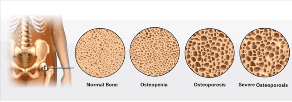 Остеопения. Остеопения и остеопороз. Остеопении что это такое. Остеопения при остеопорозе.