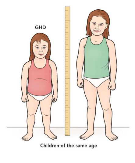 growth hormone deficiency dwarfism