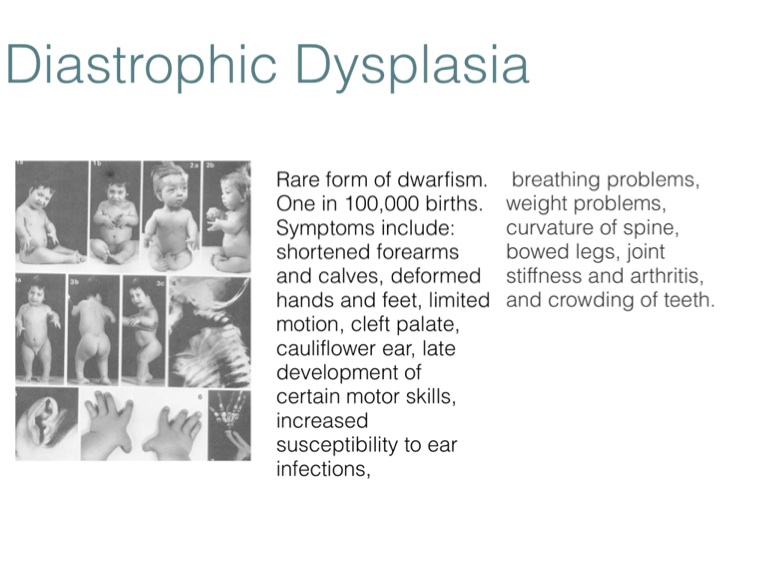diastrophic dysplasia ear
