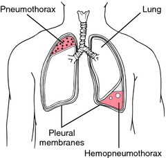 Hemopneumothorax on FlowVella - Presentation Software for Mac iPad and ...