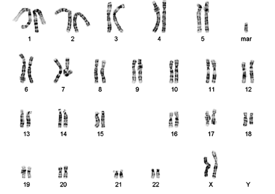 Х хромосома человека. Маркерная хромосома это. Хромосомные ФРАГМЕНТЫ И маркерные хромосомы. Маркерная хромосома у женщины кариотип. Малые сверхчисленные маркерные хромосомы.