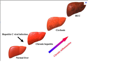 Liver Cancer on FlowVella - Presentation Software for Mac iPad and iPhone