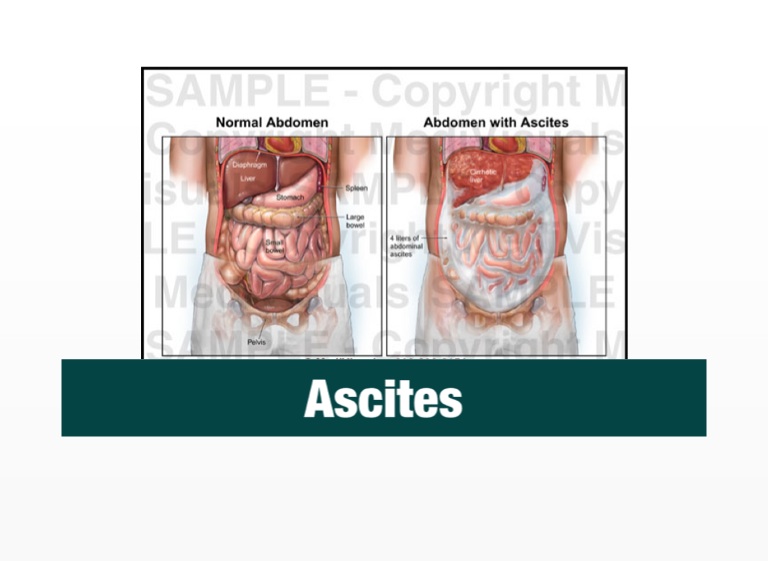 Ascites In Abdomen