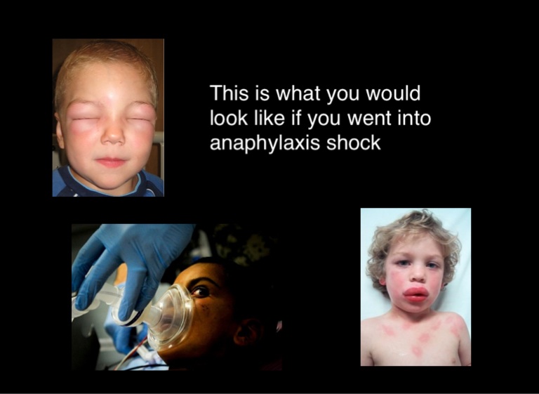 Anaphylaxis Shock Screen 6 on FlowVella Presentation Software for