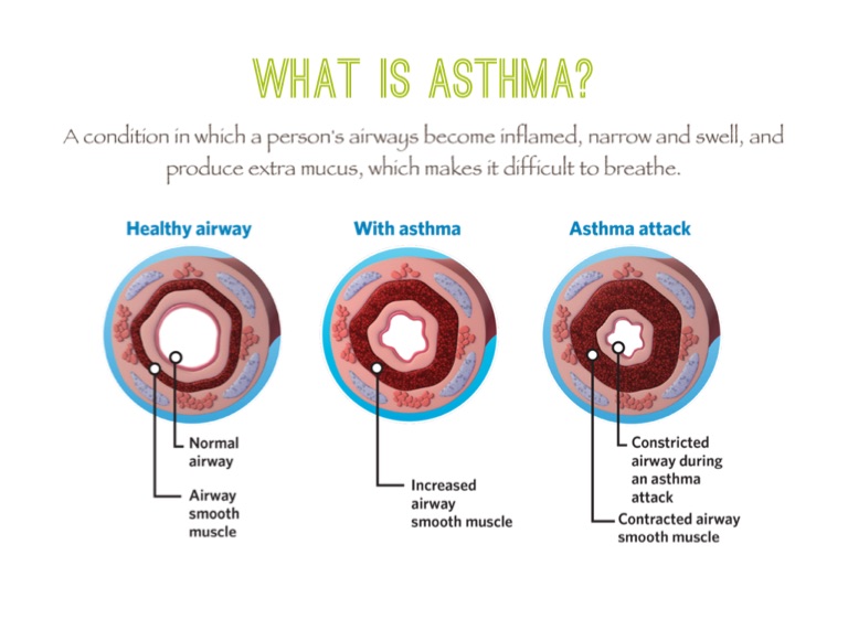 Asthma - Screen 2 on FlowVella - Presentation Software for Mac iPad and ...