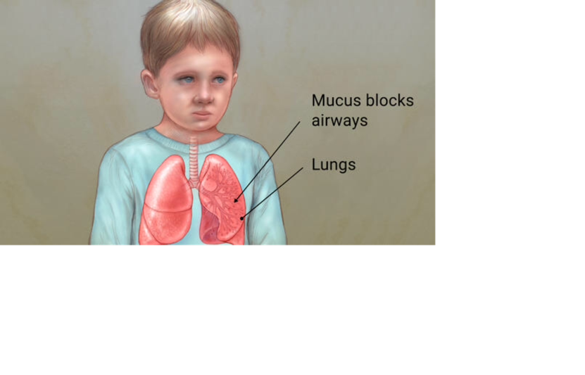 Cystic Fibrosis (Damaris & Sese) on FlowVella - Presentation Software ...